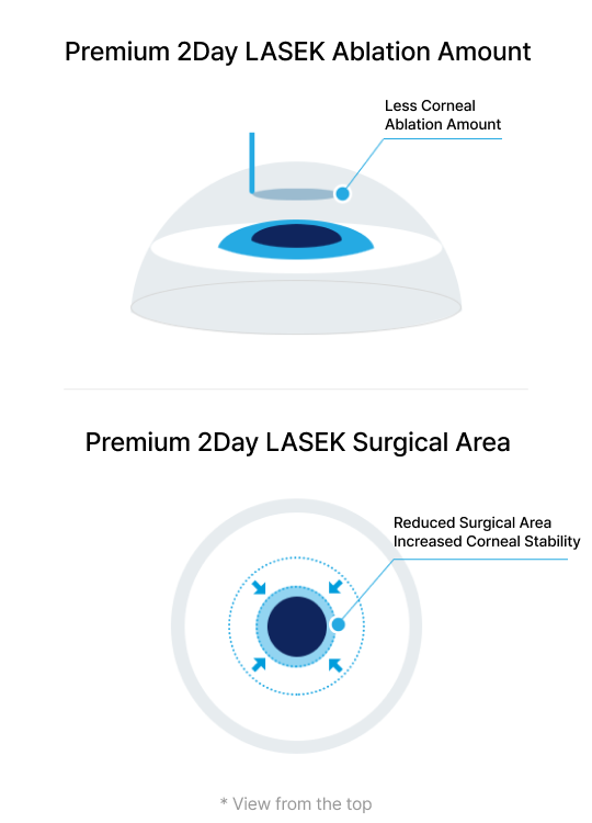 Premium 2Day LASEK
