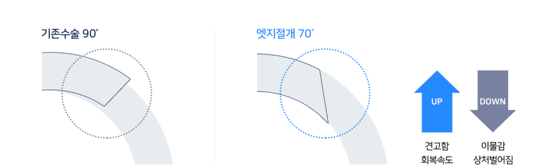 기존수술90도, 엣지절개70도 견고함 UP - 이물감 상처벌어짐