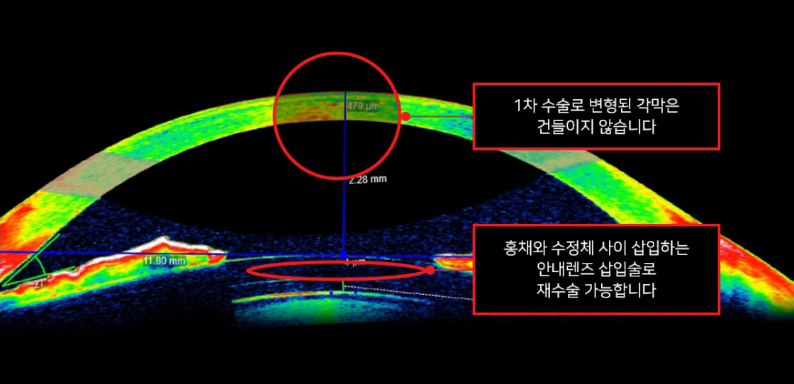 최적의 ICL 재교정  이미지 