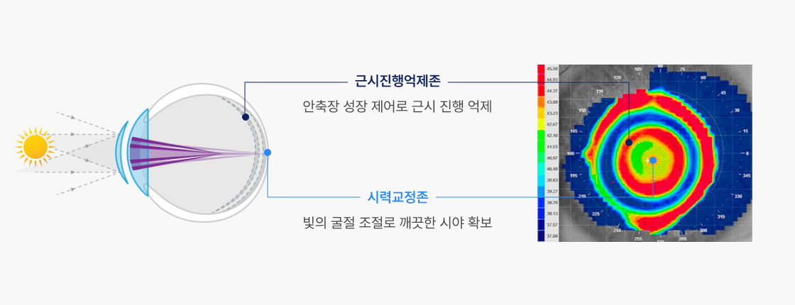 근시진행억제존 -안축장 성장 제어로 근시 진행 억제 , 시력교정존 - 빛의 굴절 조절로 깨끗한 시야 확보 