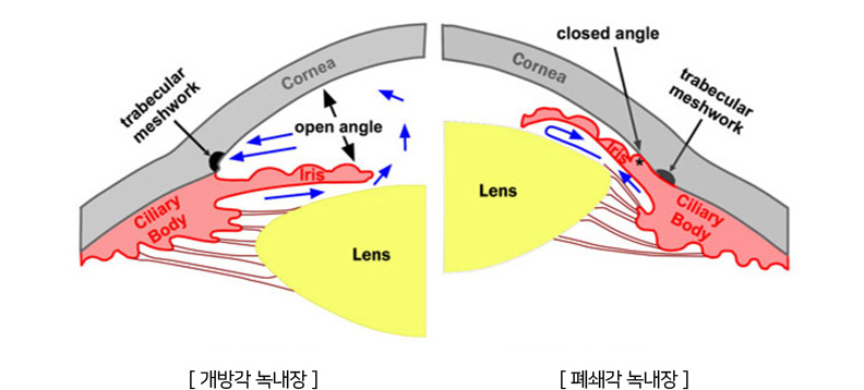 개방각 녹내장 폐쇄각 녹내장